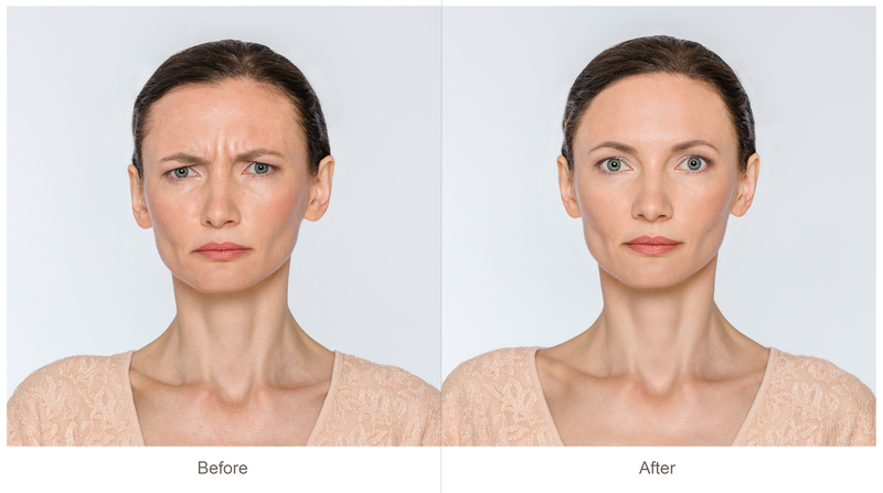 ¿Cuánto tardan en desaparecer las arrugas después del botox?
